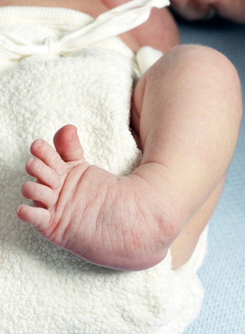 The photo depicts an infant with talipes (club foot).